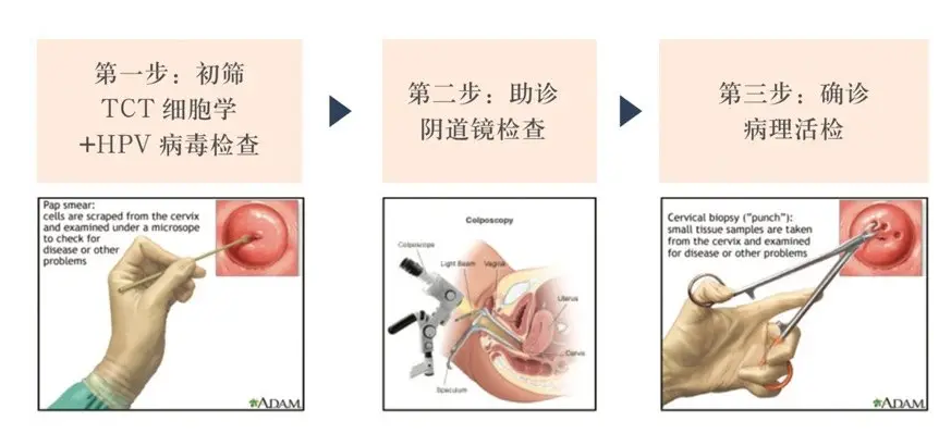 什么情況下需要宮頸活檢？一文說清宮頸活檢的意義