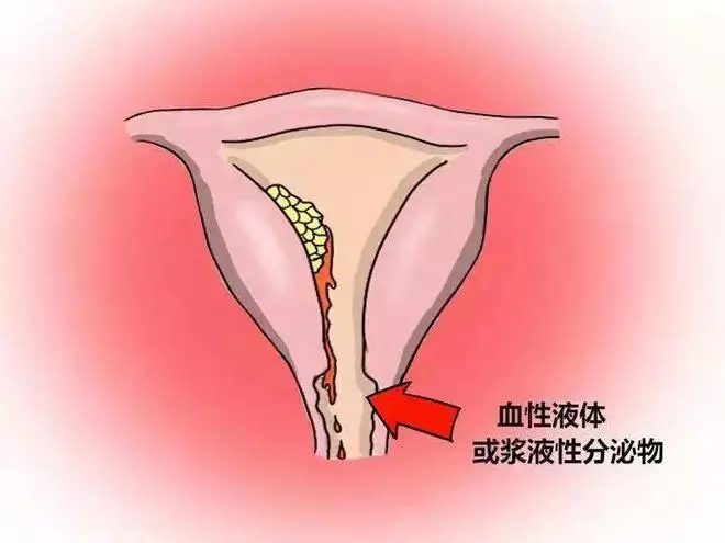女性非經(jīng)期出血，可能是什么原因？